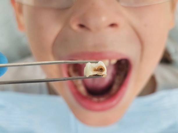 Best Emergency Gum Treatment in Aurora, OH